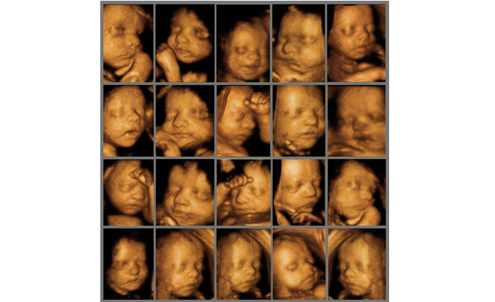 Gebelikte 4 boyutlu ultrason dönemi