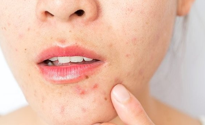 İşte sivilceye karşı dikkat edilmesi gerekenler...