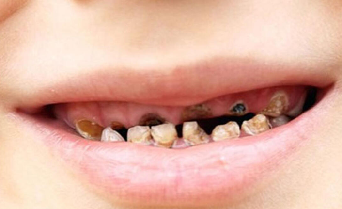 Çocuklarda diş çürüğüne dikkat!