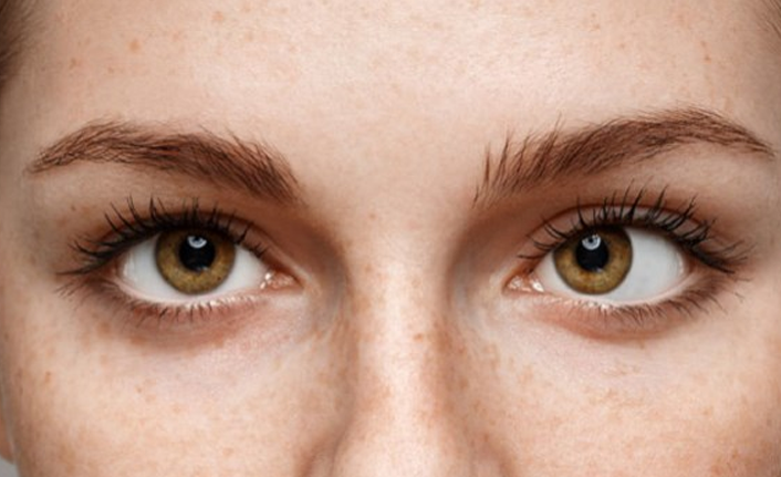 Şaşılık tedavisinde erken teşhis önemli