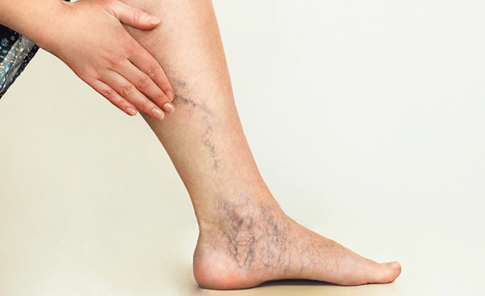 Varis tedavisinde kapalı yöntem: "Embolizan Ajan Tedavisi"