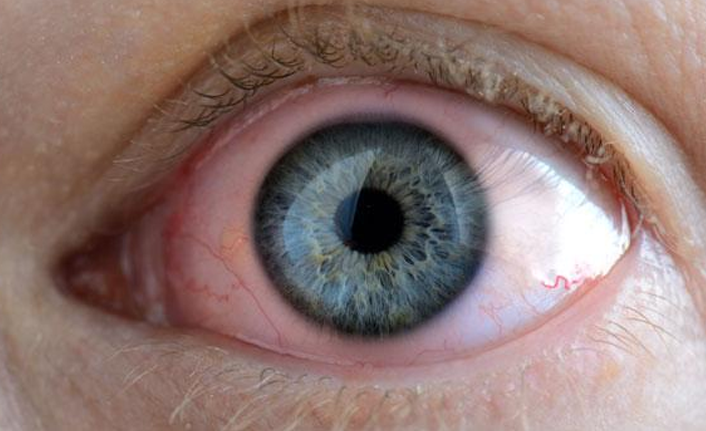 Gözlerde oluşan kırmızılığa dikkat!