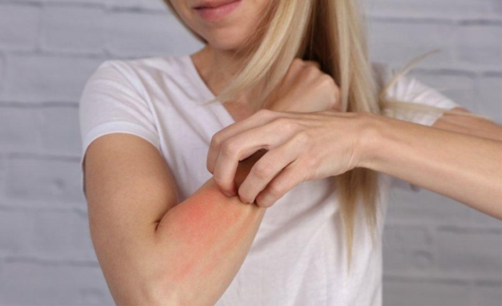 İşte yaz mevsiminde en sık görülen 6 alerji!