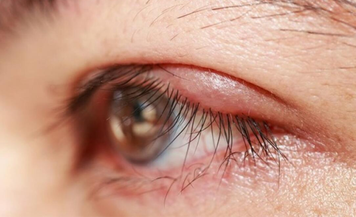 Göz iltihabı belirtilerine dikkat !