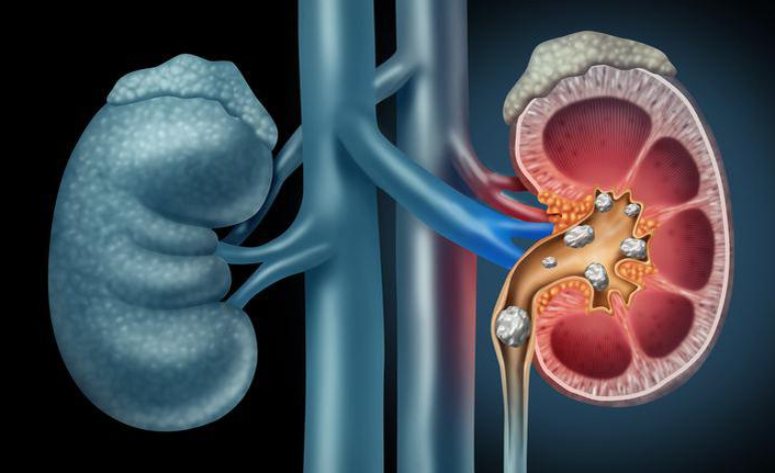 Yetersiz sıvı alımı "Taş Hastalığı"na yol açıyor