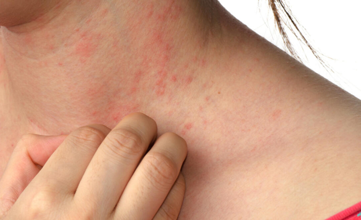 ''Uyuz, kişiden kişiye 20 dakika üzeri sıkı temasla bulaşır’’