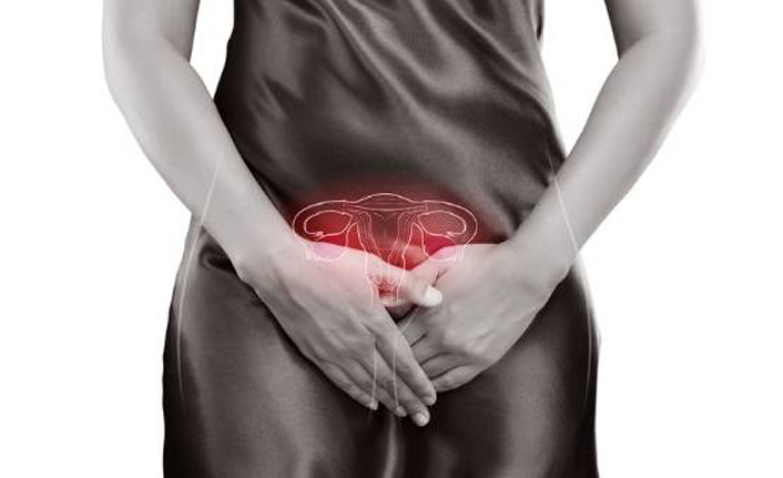 Kadınların kabusu: " Çikolata Kisti"