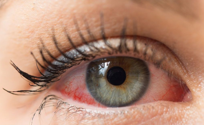 “Göz alerjisini hafife almayın”