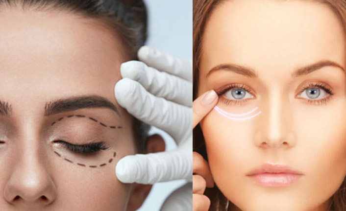Ameliyatsız göz kapağı estetiği nedir? Ameliyatsız göz kapağı estetiği nasıl uygulanır?