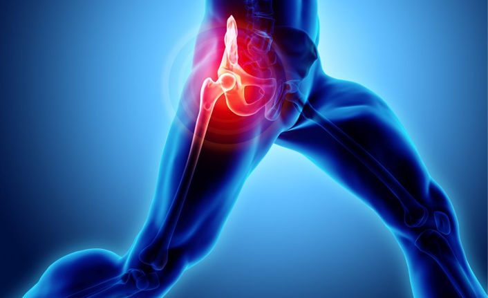 Geçmeyen kalça ağrılarınız varsa...