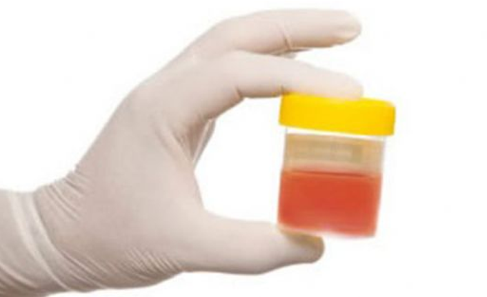 “İdrarda görülen kanama mesane kanserinin habercisi olabilir”