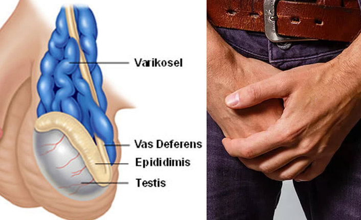 Varikosel hastalığı nedir? Varikosel belirtileri ve tedavisi nasıldır?