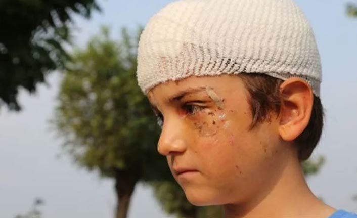 8 yaşında çocuk dehşeti yaşadı! Köpek saldırdı, kafasına 52 dikiş atıldı