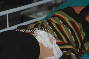 Şiş çocuğun sırtına saplandı