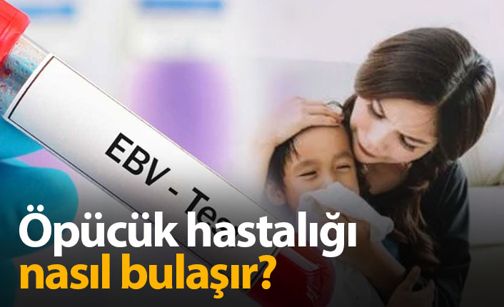 Öpücük Hastalığı Nasıl Bulaşır ? Öpücük Hastalığı nedir?