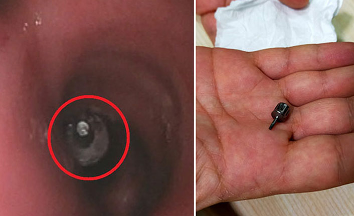 Akciğerine diş implant parçası kaçtı