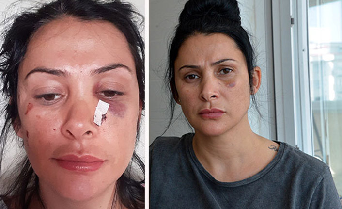 Öğretmen kadın, komşusunun yüzüne kalem sapladı