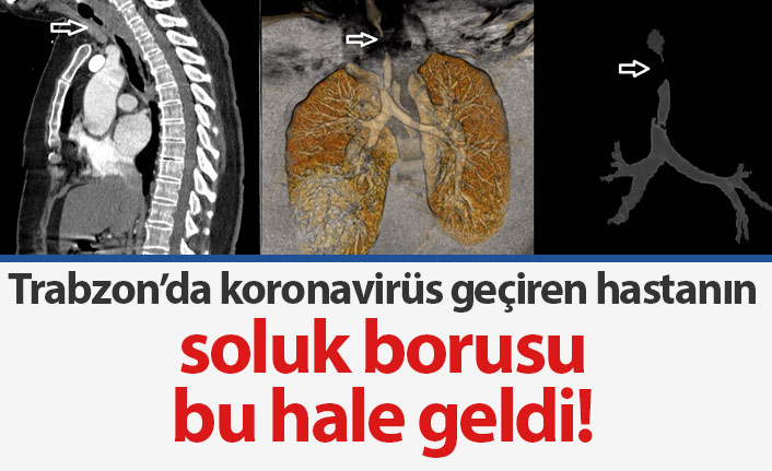 Trabzon'da koronavirüs geçiren hastanın soluk borusunda daralma oluştu