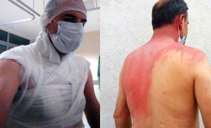 Sigara dumanı yüzünden komşusunu kaynar suyla yaktı