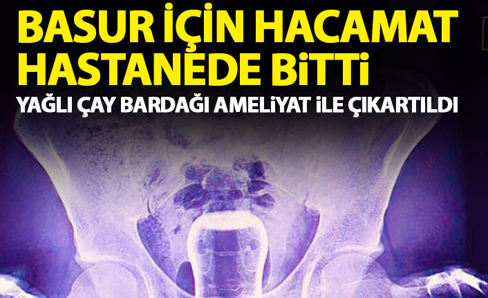 Basur için hacamat hastanede bitti