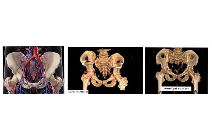 Leğen kemiğinde 7 kırık 6 saatten düzeltildi
