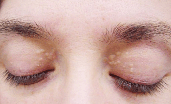 "Göz çevresi kolesterole işaret edebilir"