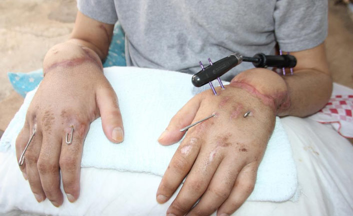 Ellerini kaybeden işçi yardım eli bekliyor