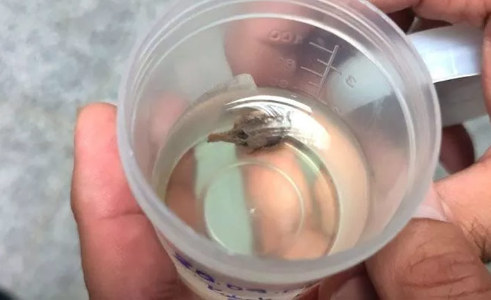 Öksürük şikayetiyle hastaneye gitti, akciğerinden çekirdek çıktı