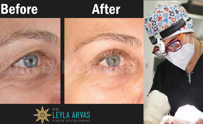 Göz Kapağı Estetiği Nedir? Göz Kapağı Estetiği Ameliyatı Nasıl Yapılır?