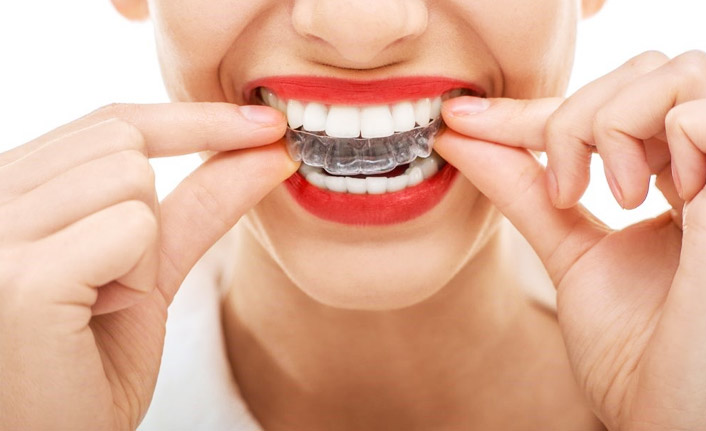 Şeffaf Plak tedavisi nedir? Şeffaf Plak tedavisinde tüm detaylar