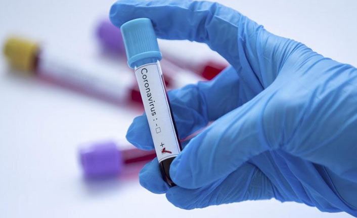 Türkiye'de 77 bin 722 yeni Kovid-19 vakası tespit edildi