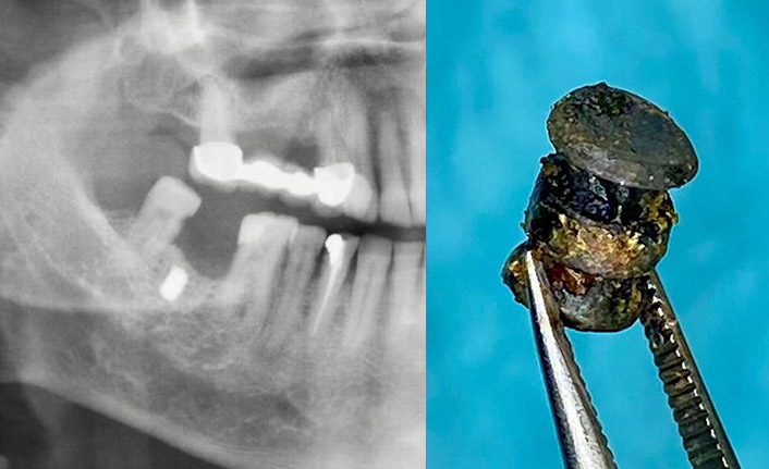 Yanağına saplanan metal parçasıyla 15 yıl yaşadı