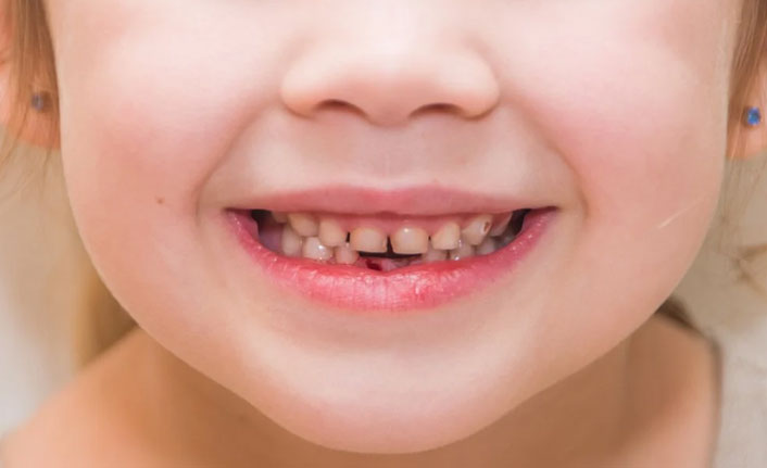 Çocuklarda biberon çürüğüne dikkat!