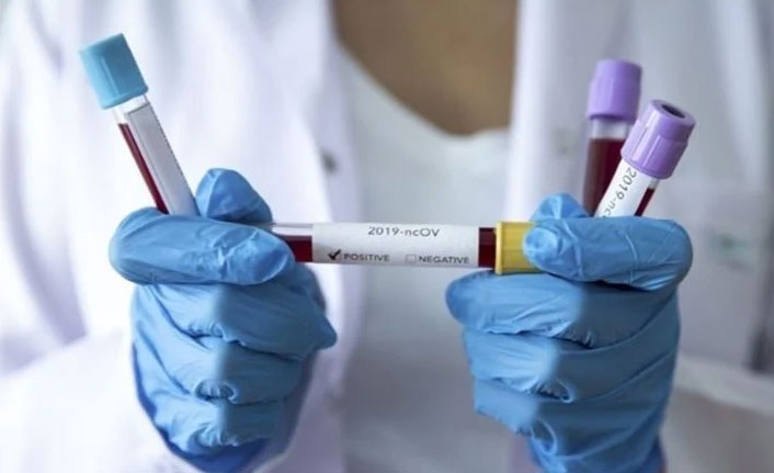 Türkiye’de son 24 saatte 87 bin 934 yeni Kovid-19 vakası