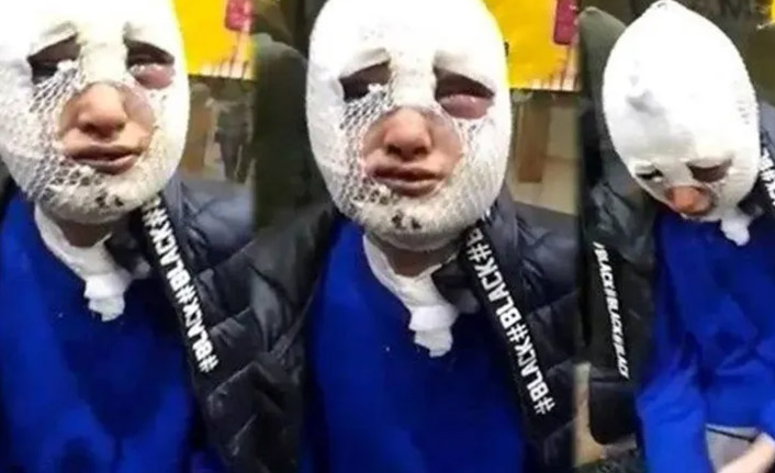 Eski kız arkadaşının başından aşağı kızgın yağ dökmüştü, tutuklandı