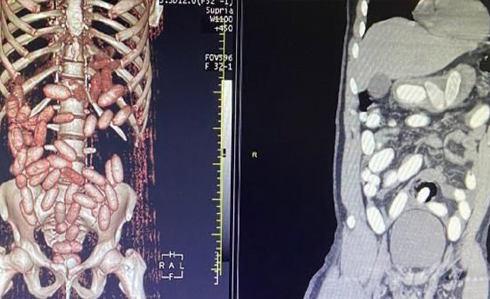 7 yolcunun midesinden 11 kilo kokain çıktı