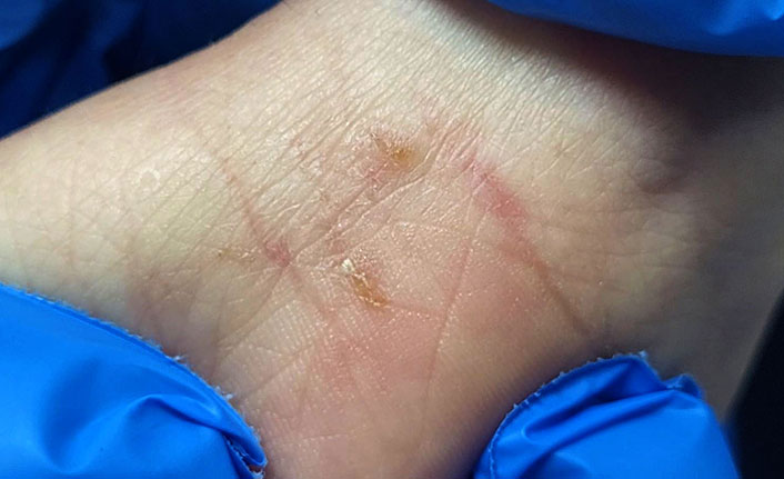 Trabzon'da uzmanlardan 'uyuz' uyarısı