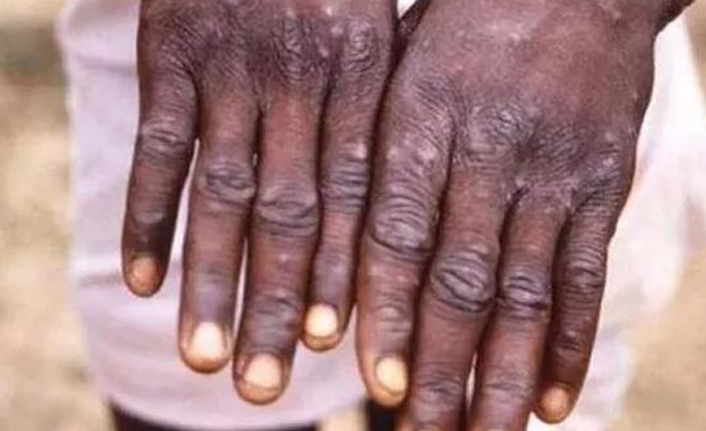 Dünya diken üstünde! Maymun çiçeği virüsü yayılmaya devam ediyor