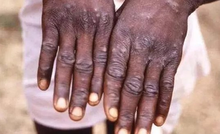 DSÖ dünya genelindeki Maymun Çiçeği virüsü vaka sayısını açıkladı