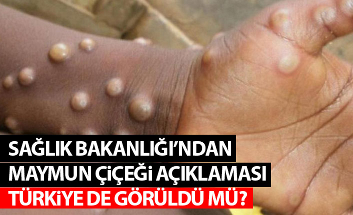Sağlık Bakanlığı'ndan Maymun çiçeği açıklaması