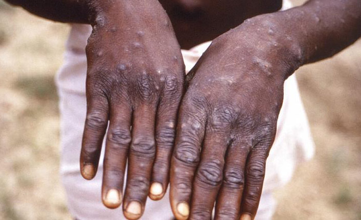 Bakan Koca'dan Maymun Çiçeği virüsü açıklaması geldi! Türkiye'de rastlandı mı?