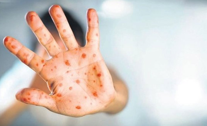 Maymun çiçeği hızla yayılıyor! İşte hastalığın 6 belirtisi