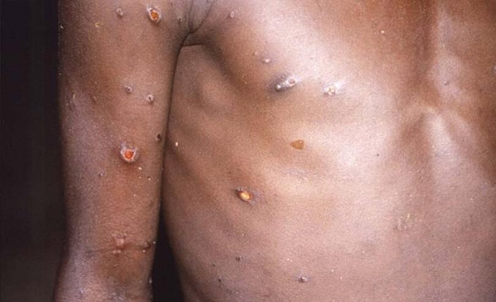 Maymun Çiçeği virüsünde ilk ölüm!