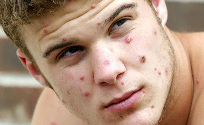 Maymun Çiçeği pandemiye yol açar mı? İşte cevabı