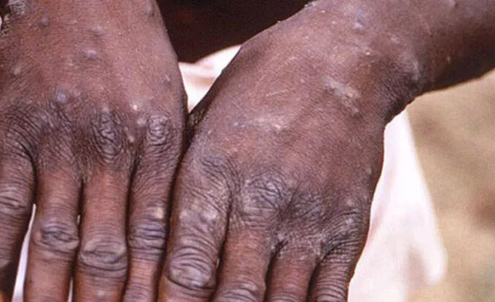 "Maymun Çiçeği'ne ırkçılık suçlaması" yeniden adlandırılacak