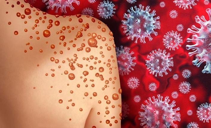 Maymun çiçeği Türkiye'nin etrafını sarıyor o ülkede de görüldü