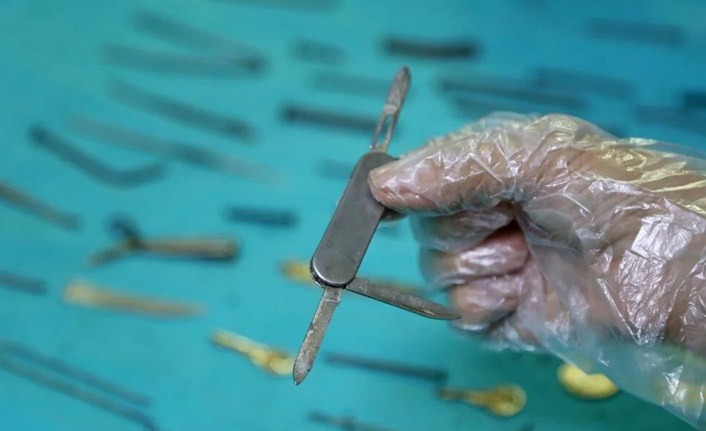 Midesinden 158 adet cisim çıktı