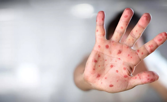 Gurbetçiler dikkat! O ülkede vaka sayıları artıyor