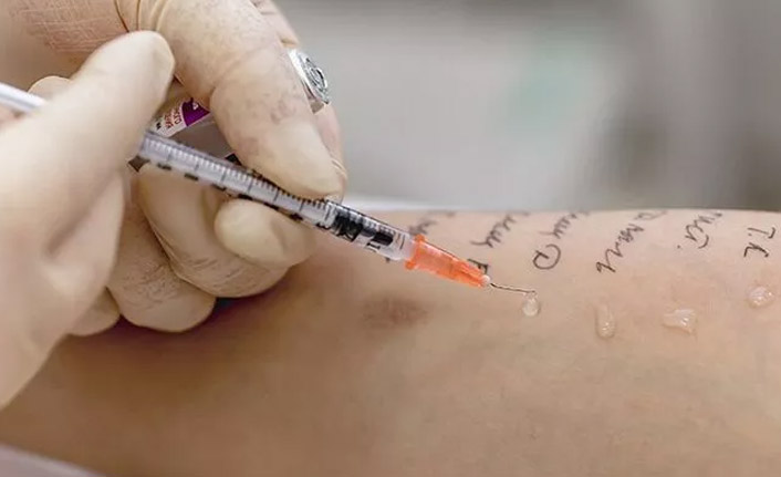 Alerji testi kime yapılır?