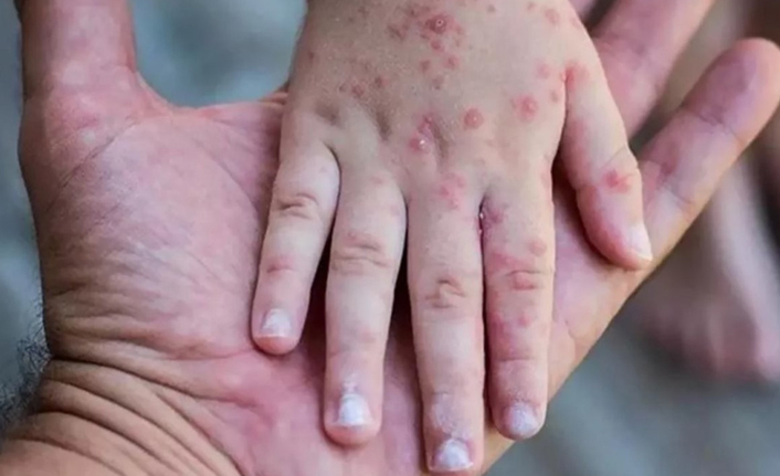 DSÖ'den flaş maymun çiçeği kararı! Küresel acil durum